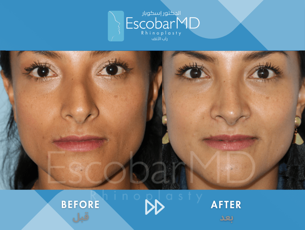 Crooked Nose Rhinoplasty with Dorsal Hump Correction in Dubai 3 Case 04 Deviated Nose Dr Escobar Dubai (2)