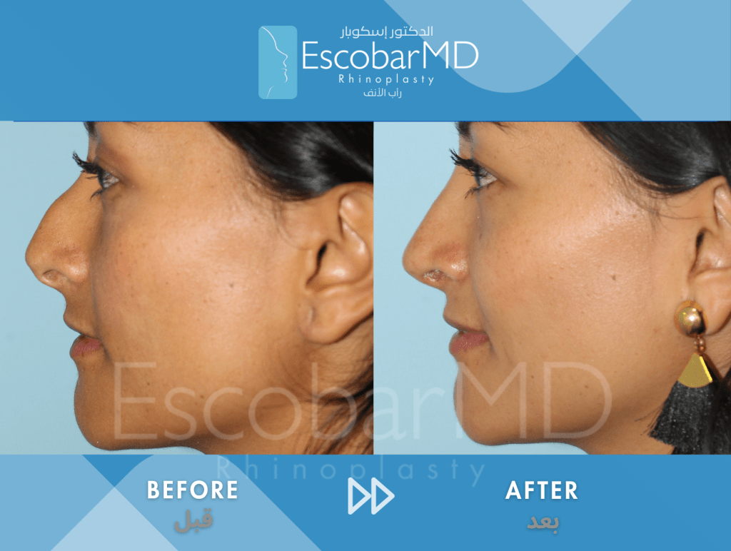 Crooked Nose Rhinoplasty with Dorsal Hump Correction in Dubai 5 Case 04 Deviated Nose Dr Escobar Dubai (5)