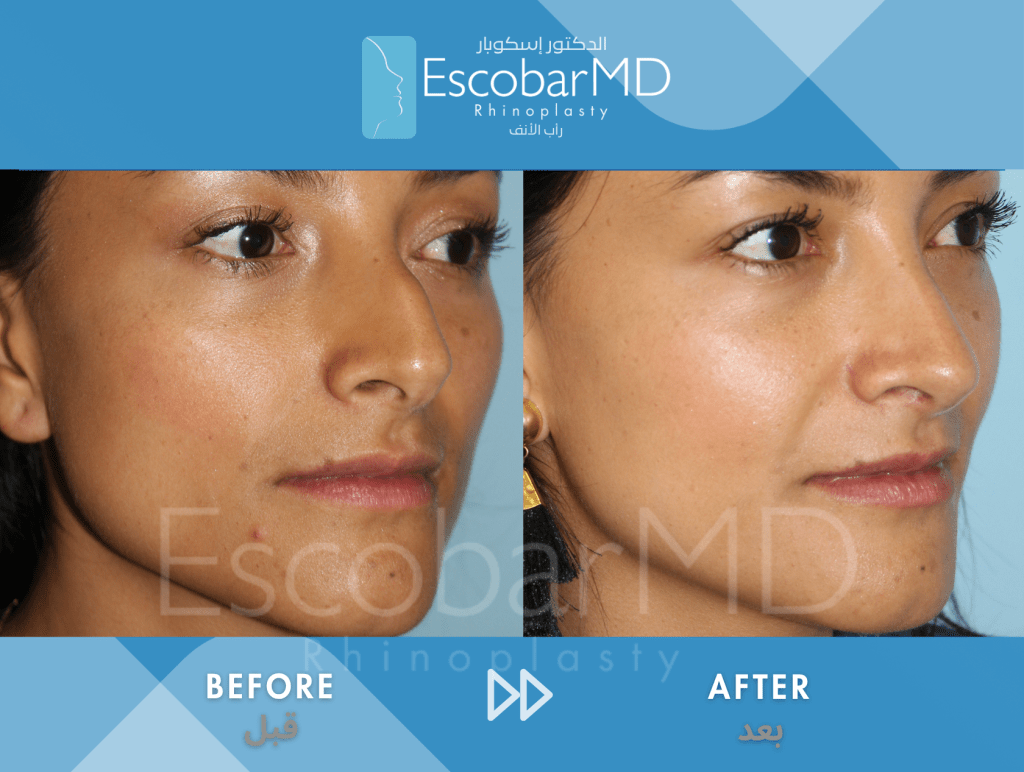 Crooked Nose Rhinoplasty with Dorsal Hump Correction in Dubai 6 Case 04 Deviated Nose Dr Escobar Dubai (6)