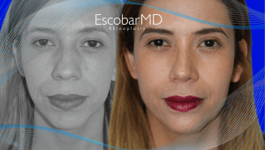 Before After Closed Rhinoplasty in Dubai 6 Case 05 Closed Ethnic Rhinoplasty