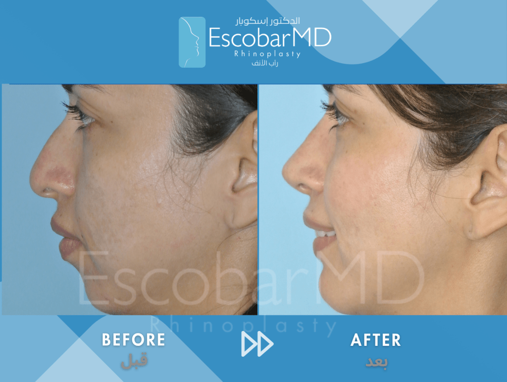 Female Closed Rhinoplasty with Chin Implant & Buccal Fat Removal in Dubai 2 Case 06 Primary Structural Rhinoplasty Dr Escobar Dubai (2)