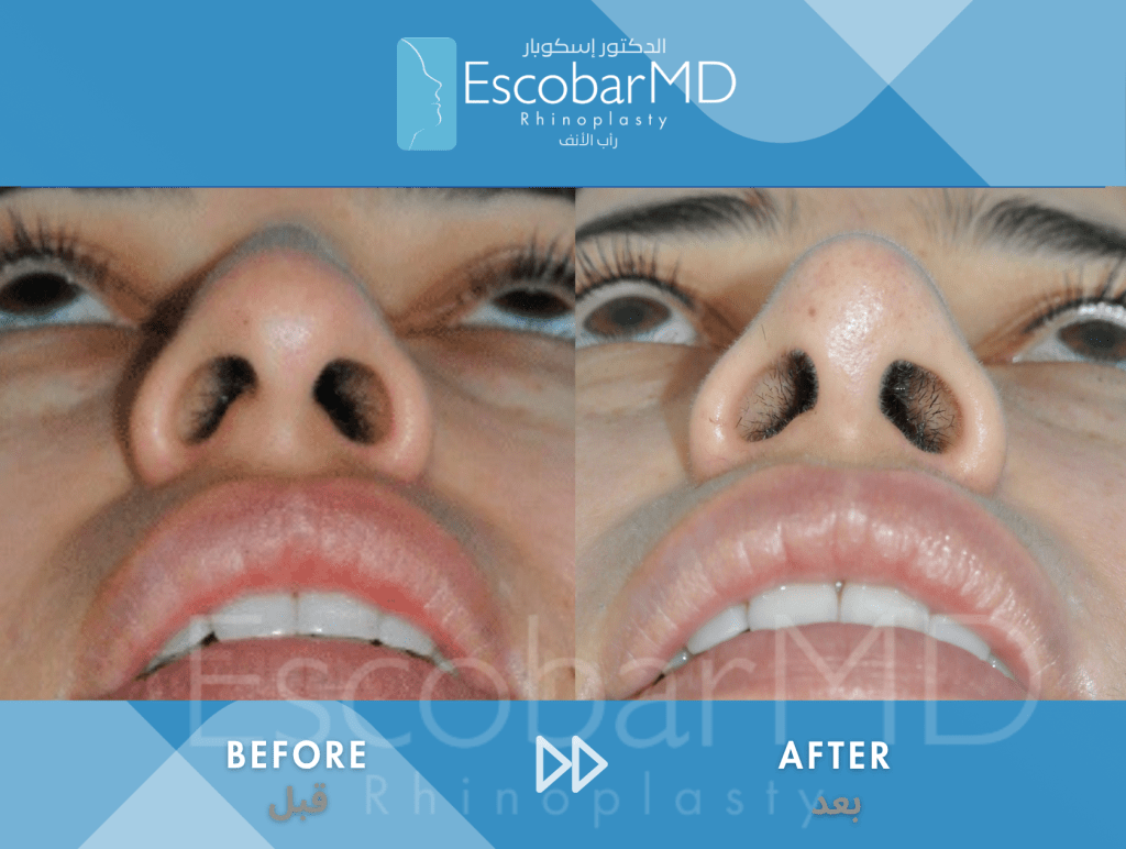 Female Closed Rhinoplasty with Chin Implant & Buccal Fat Removal in Dubai 6 Case 06 Primary Structural Rhinoplasty Dr Escobar Dubai (6)