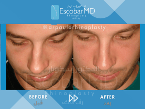 Septoplasty in Dubai with Dr. Escobar| Functional Nose Surgery 6 Before and after images showcasing the results of a septoplasty procedure, highlighting changes in the nasal structure and alignment.