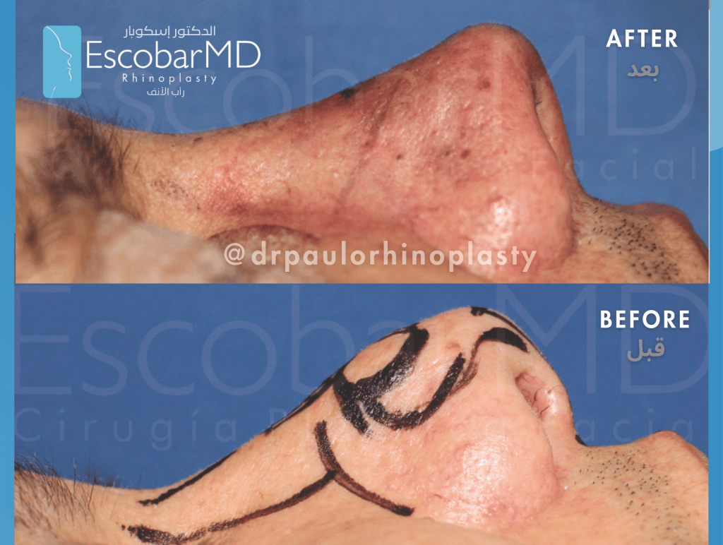 Revision Rhinoplasty in Dubai with Dr. Escobar 8 Before and after images showcasing the results of revision rhinoplasty, highlighting the improvement in nasal shape and appearance.