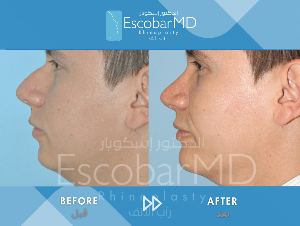 Closed Male Rhinoplasty with Chin Implant in Dubai 4 Case 07 Primary Male Rhinoplasty Dr Escobar Dubai (1)