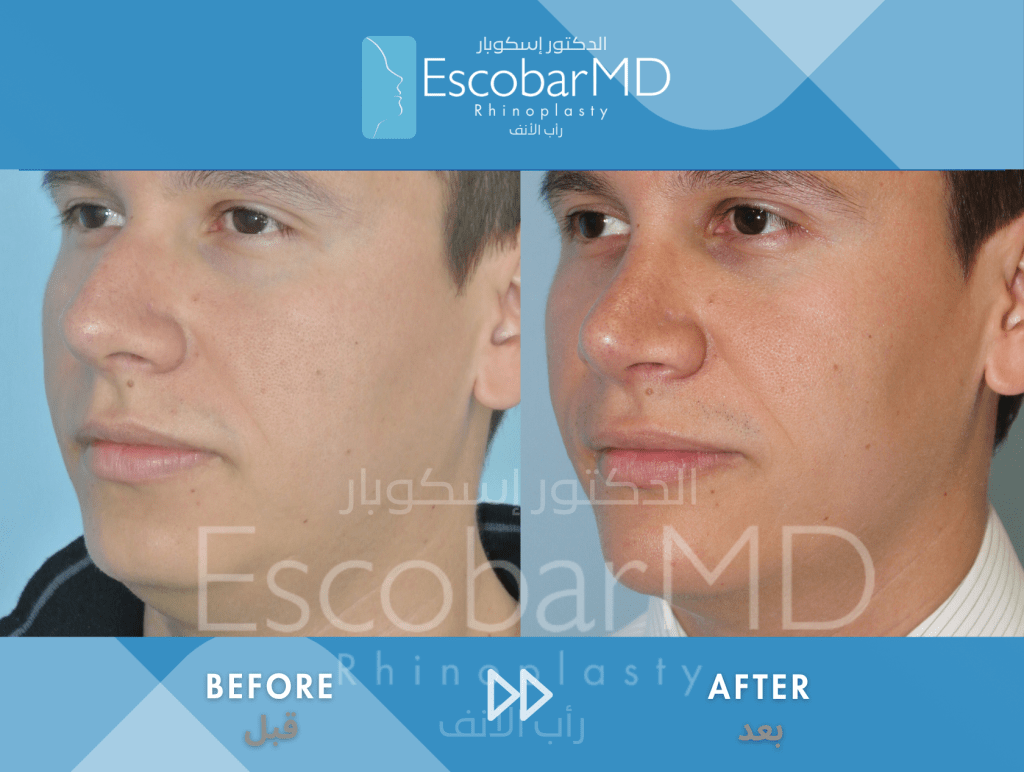 Closed Male Rhinoplasty with Chin Implant in Dubai 3 Case 07 Primary Male Rhinoplasty Dr Escobar Dubai (2)