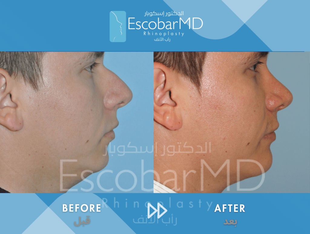 Closed Male Rhinoplasty with Chin Implant in Dubai 2 Case 07 Primary Male Rhinoplasty Dr Escobar Dubai (3)