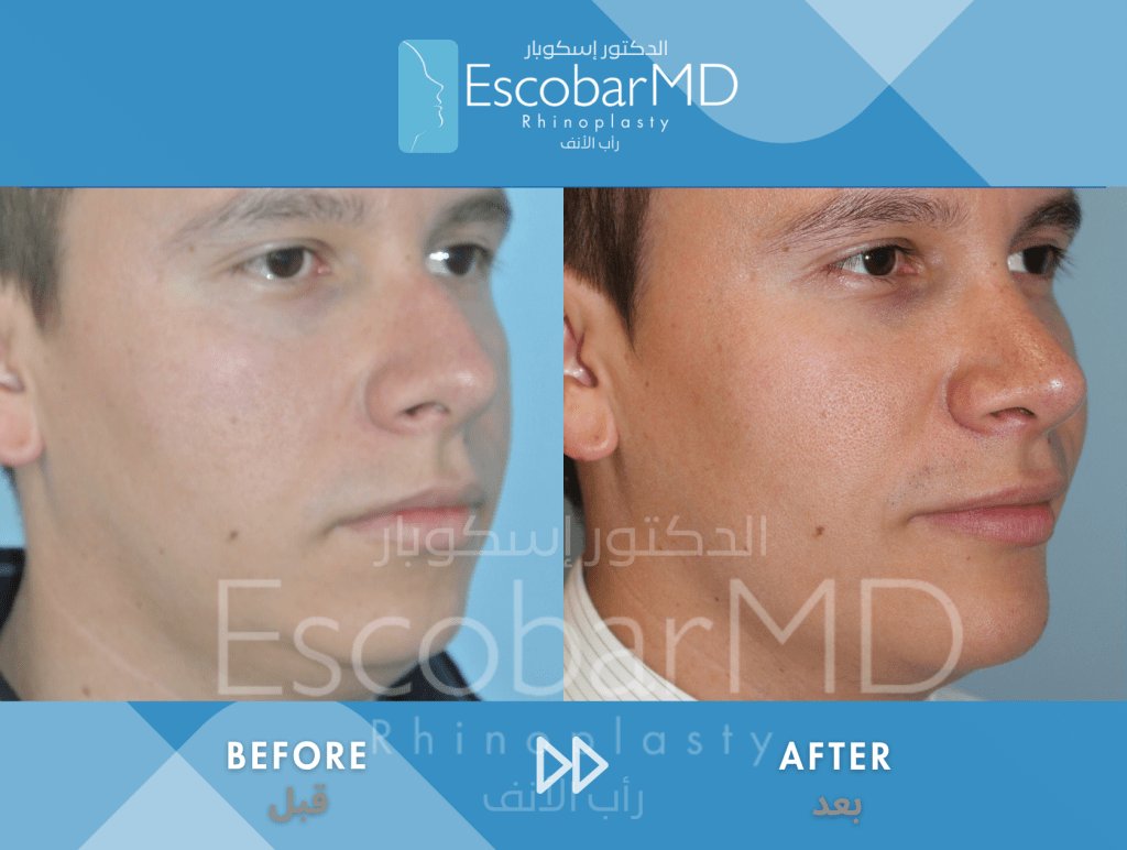 Closed Male Rhinoplasty with Chin Implant in Dubai 1 Case 07 Primary Male Rhinoplasty Dr Escobar Dubai (4)
