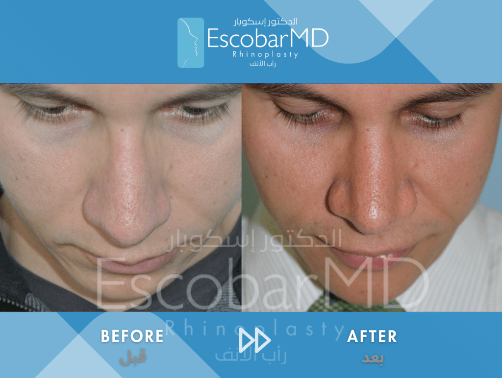 Closed Male Rhinoplasty with Chin Implant in Dubai 6 Case 07 Primary Male Rhinoplasty Dr Escobar Dubai (5)