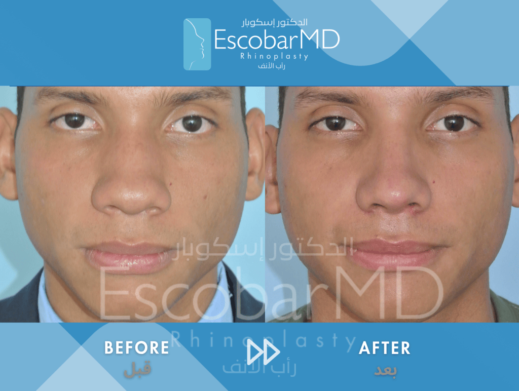 Men’s Afro Rhinoplasty in Dubai (Afro Nose Surgery) 2 Case 11 Afro Male Rhinoplasty Dr Escobar Dubai (2)