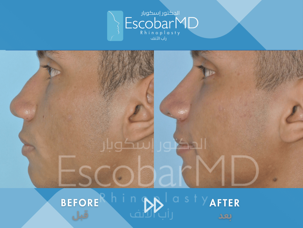 Men’s Afro Rhinoplasty in Dubai (Afro Nose Surgery) 1 Case 11 Afro Male Rhinoplasty Dr Escobar Dubai (4)