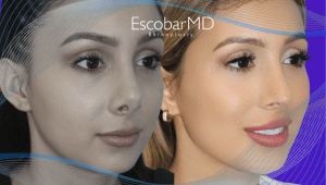 Before After Revision Rhinoplasty in Dubai 2 Case 14 Revision Rhinoplasty Dr Escobar Dubai