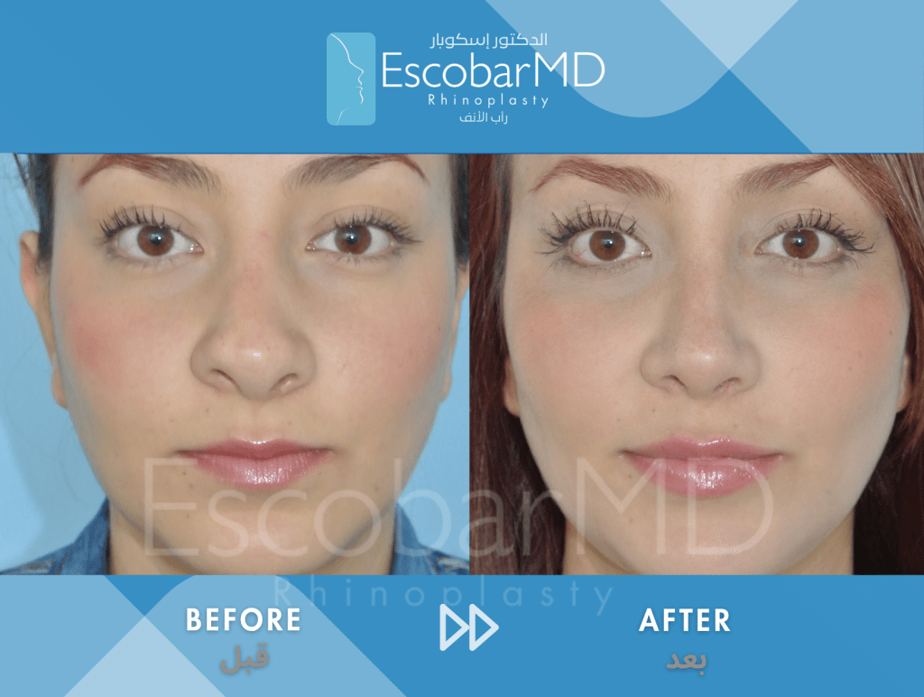 Closed Revision Rhinoplasty in Dubai 2 Case 15 Revision Rhinoplasty Dr Escobar Dubai (1)