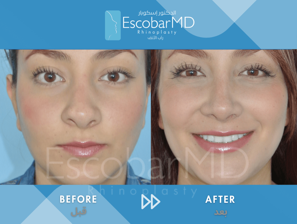 Closed Revision Rhinoplasty in Dubai 1 Case 15 Revision Rhinoplasty Dr Escobar Dubai (2)
