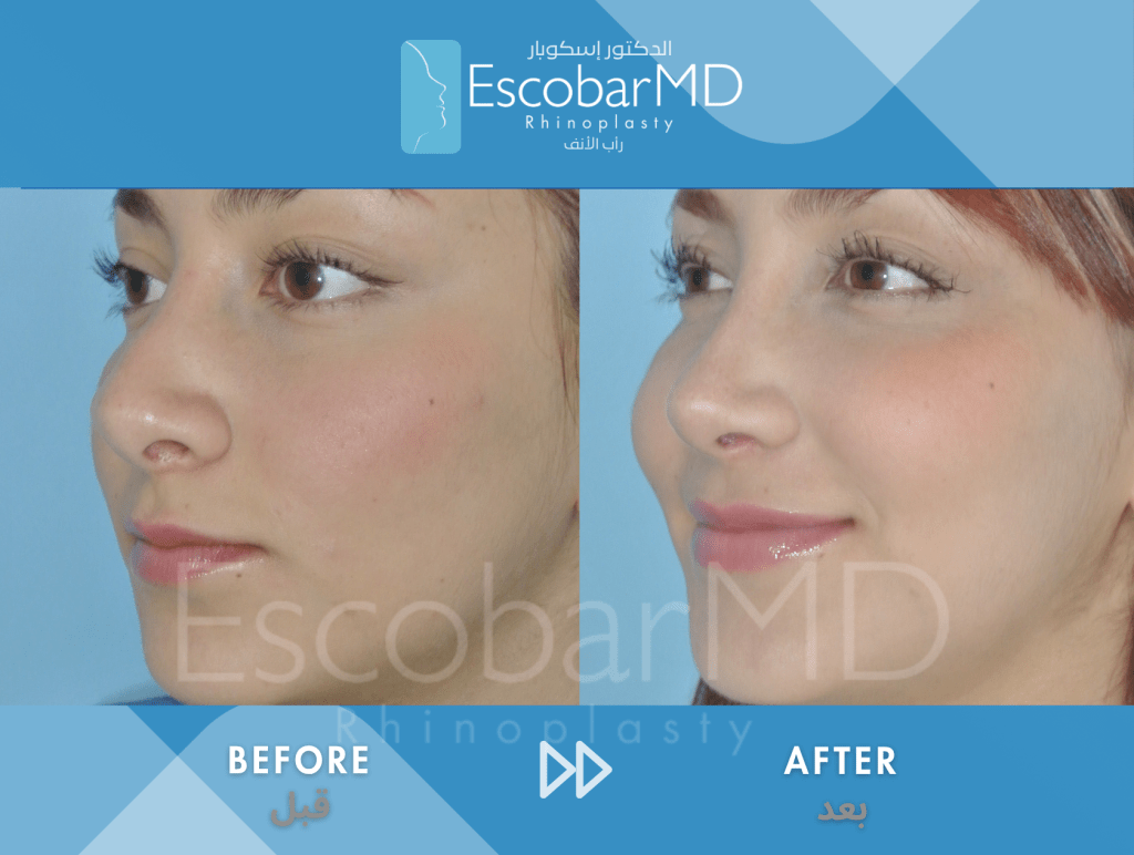 Closed Revision Rhinoplasty in Dubai 3 Case 15 Revision Rhinoplasty Dr Escobar Dubai (3)