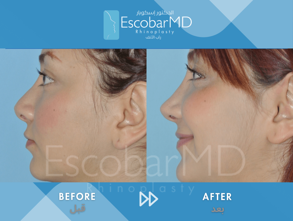 Closed Revision Rhinoplasty in Dubai 4 Case 15 Revision Rhinoplasty Dr Escobar Dubai (4)