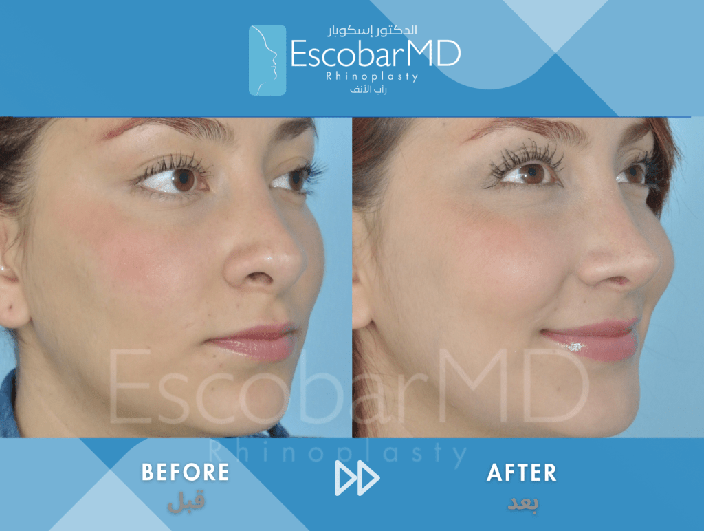 Closed Revision Rhinoplasty in Dubai 5 Case 15 Revision Rhinoplasty Dr Escobar Dubai (5)