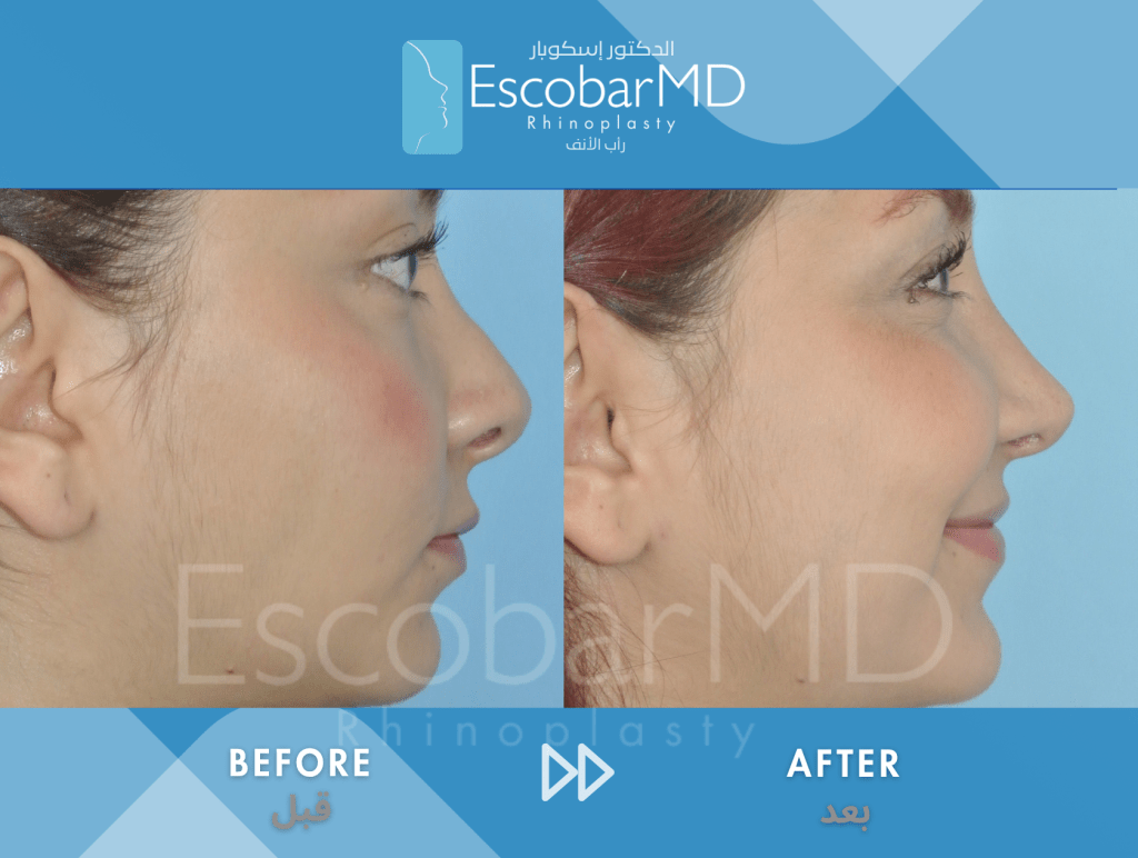 Closed Revision Rhinoplasty in Dubai 6 Case 15 Revision Rhinoplasty Dr Escobar Dubai (6)