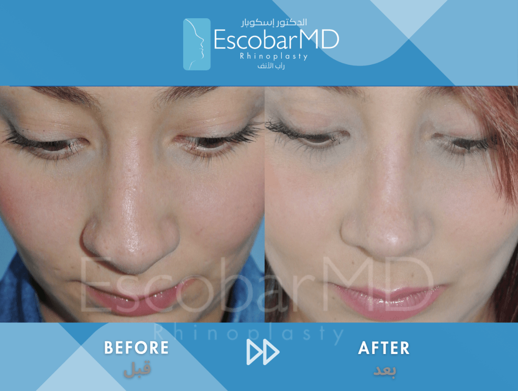 Closed Revision Rhinoplasty in Dubai 7 Case 15 Revision Rhinoplasty Dr Escobar Dubai (7)