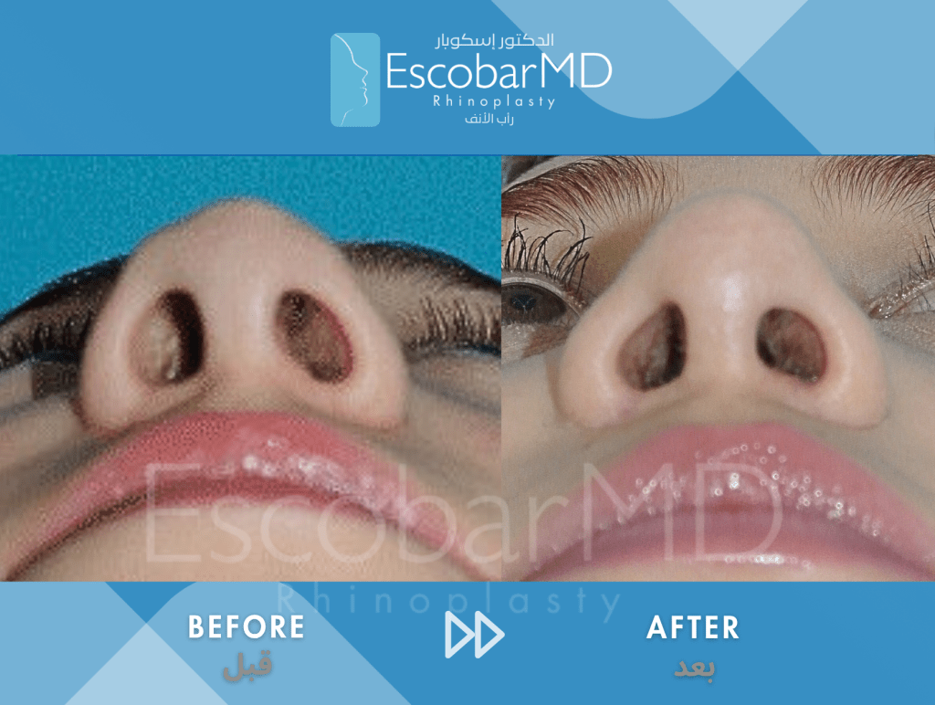 Closed Revision Rhinoplasty in Dubai 8 Case 15 Revision Rhinoplasty Dr Escobar Dubai (8)