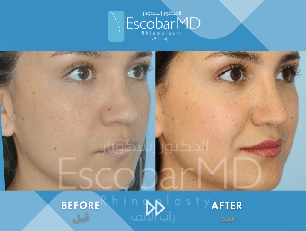 Closed Secondary Rhinoplasty for Bulbous Nasal Tip in Dubai 3 Case 18 Closed Secondary Rhinoplasty Dr Escobar Dubai (14)