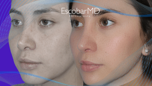 Before After Revision Rhinoplasty in Dubai 8 Case 19 Revision Rhinoplasty Dr Escobar Dubai