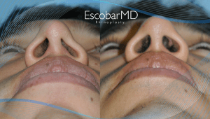 Before After Revision Rhinoplasty in Dubai 10 Case 20 Closed Revision Rhinoplasty Dr Escobar