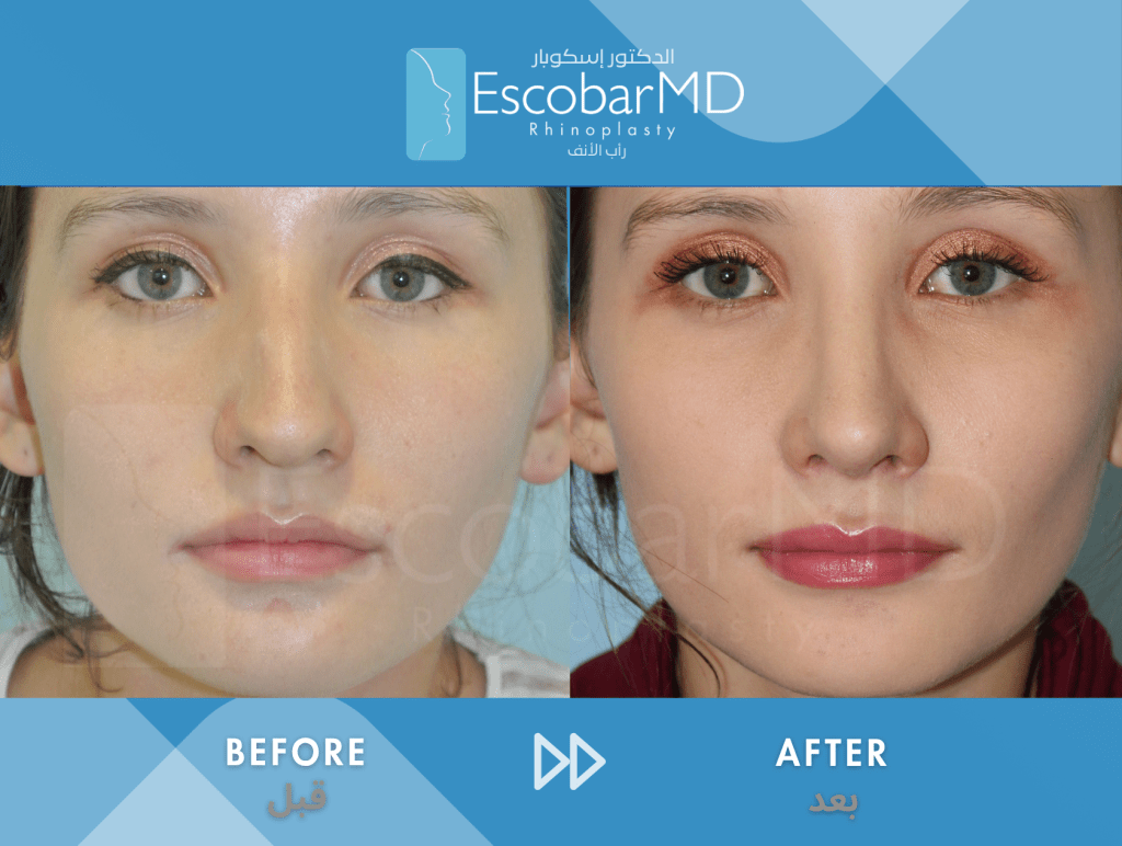 Female Closed Rhinoplasty in Dubai 3 Case 3 Closed Rhinoplasty Dr Escobar Dubai (1)