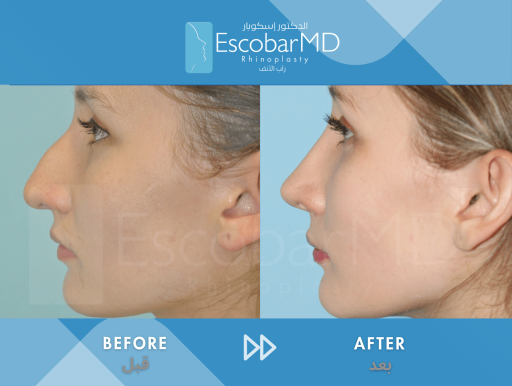 Female Closed Rhinoplasty in Dubai 2 Case 3 Closed Rhinoplasty Dr Escobar Dubai (2)