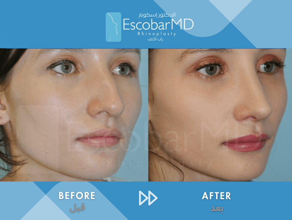 Female Closed Rhinoplasty in Dubai 4 Case 3 Closed Rhinoplasty Dr Escobar Dubai (3)