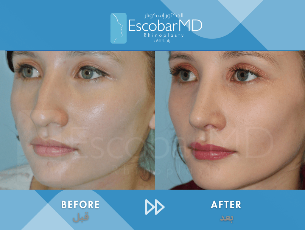Female Closed Rhinoplasty in Dubai 5 Case 3 Closed Rhinoplasty Dr Escobar Dubai (4)