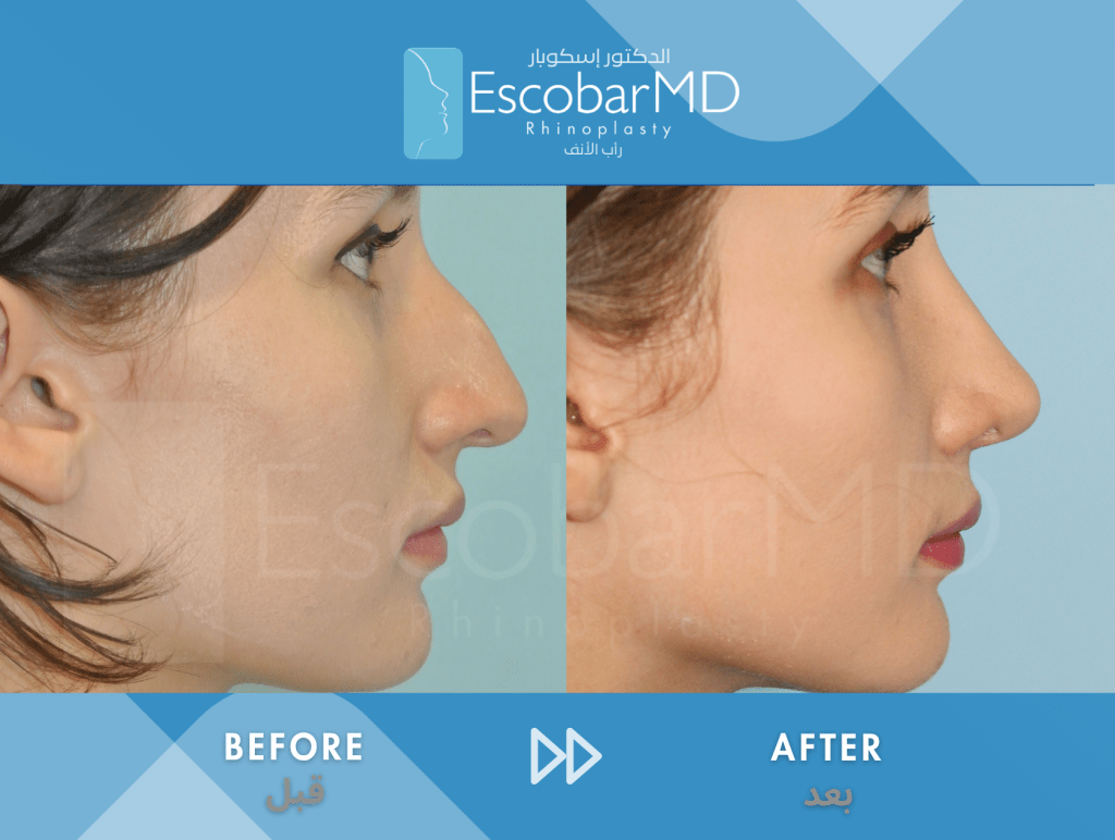 Female Closed Rhinoplasty in Dubai 6 Case 3 Closed Rhinoplasty Dr Escobar Dubai (5)