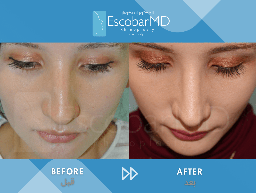 Female Closed Rhinoplasty in Dubai 7 Case 3 Closed Rhinoplasty Dr Escobar Dubai (6)