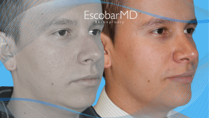 Rhinoplasty in Men Dubai with Dr. Escobar 4 Case 7 Male Rhinoplasty Chin Surgery Dr Escobar Dubai
