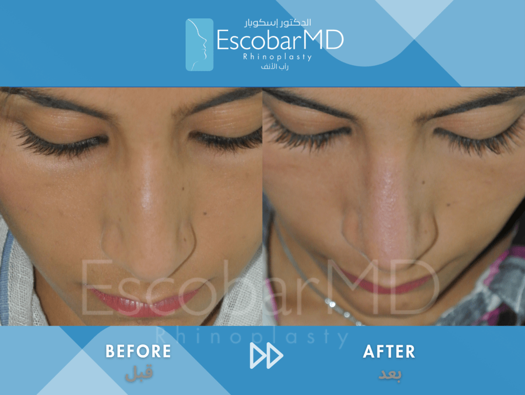 Female Scarless Rhinoplasty with Dorsal Hump Removal in Dubai 4 Close Ethnic Rhinoplasty Dr Escobar Dubai (1)