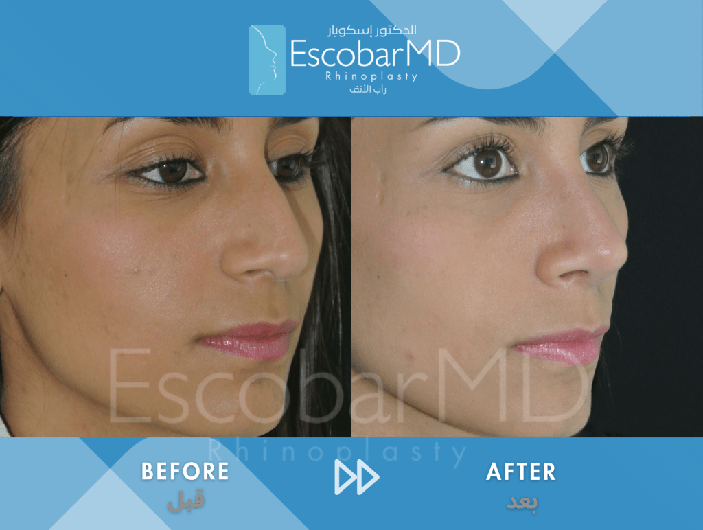 Female Scarless Rhinoplasty with Dorsal Hump Removal in Dubai 8 Close Ethnic Rhinoplasty Dr Escobar Dubai (8)