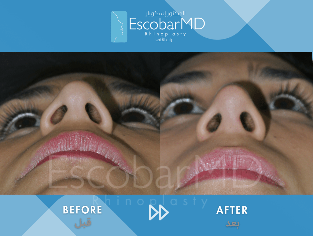 Female Scarless Rhinoplasty with Dorsal Hump Removal in Dubai 9 Close Ethnic Rhinoplasty Dr Escobar Dubai (9)