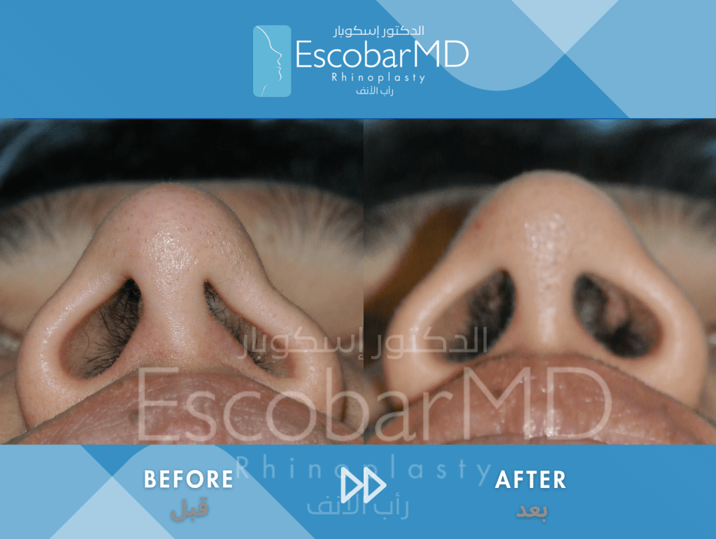 Close Revision Rhinoplasty in Men with Nasal Valve Repair Dubai 3 Close Revision Rhinoplasty Nasal Valve Repair Dr Escobar UAE (3)