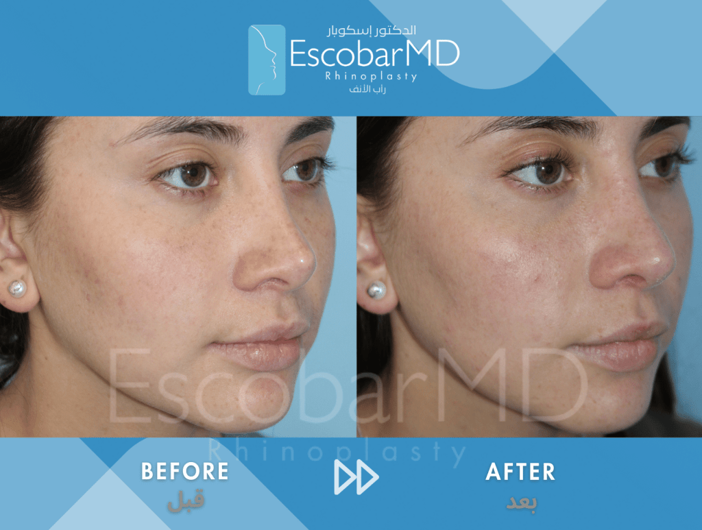 Scarless Revision Rhinoplasty for Thin Skin in Dubai 3 Close revision rhinoplasty Dr Escobar Abu Dhabi Dubai (1)