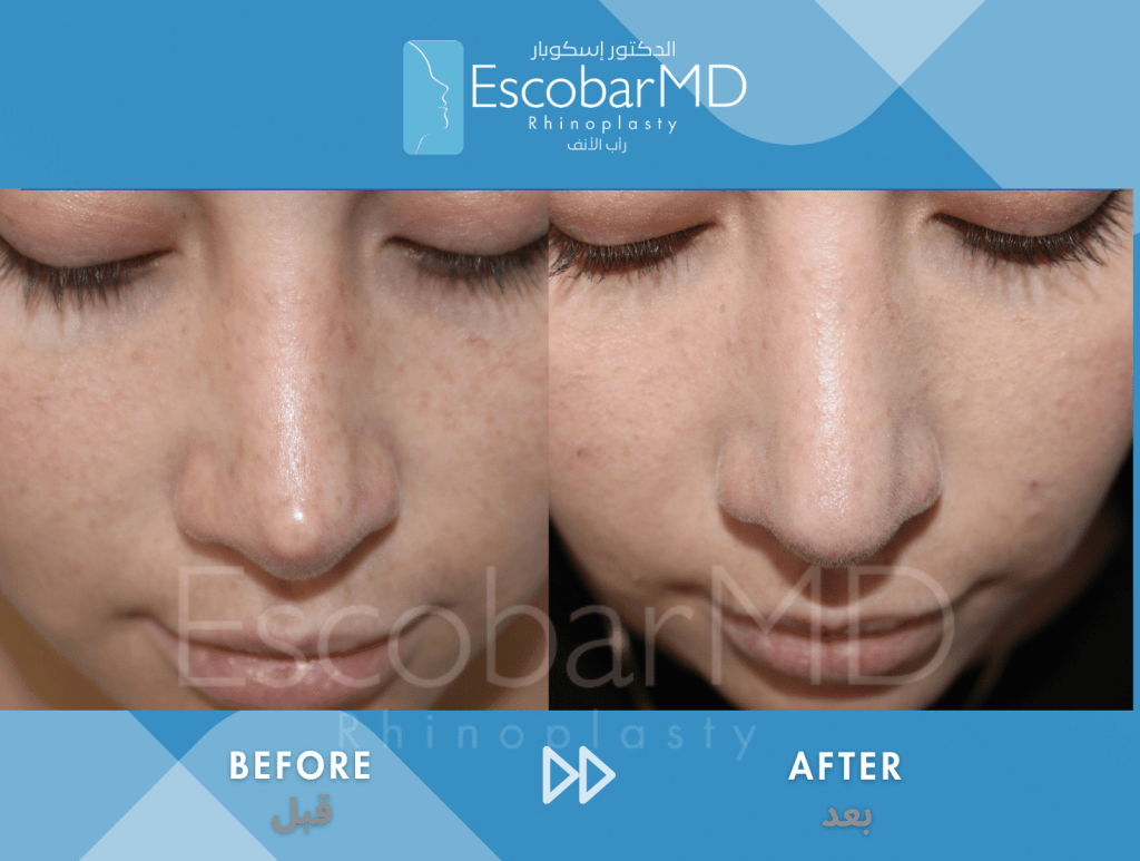 Scarless Revision Rhinoplasty for Thin Skin in Dubai 5 Close revision rhinoplasty Dr Escobar Abu Dhabi Dubai (3)