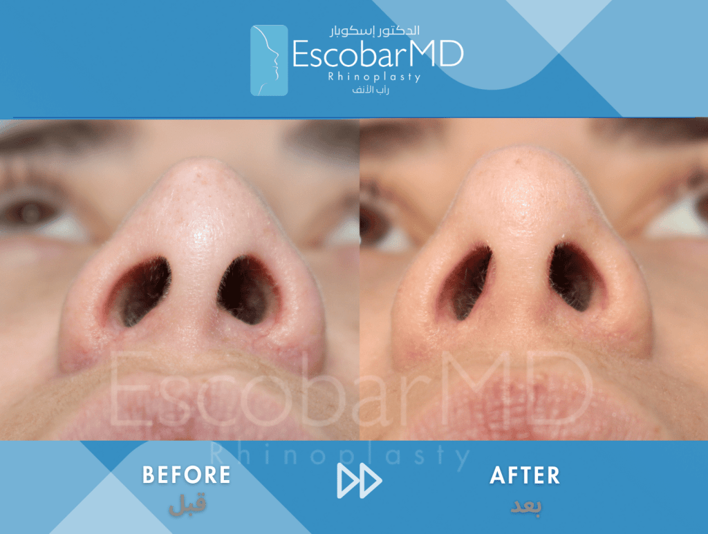 Scarless Revision Rhinoplasty for Thin Skin in Dubai 6 Close revision rhinoplasty Dr Escobar Abu Dhabi Dubai (4)