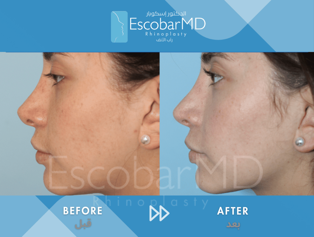 Scarless Revision Rhinoplasty for Thin Skin in Dubai 2 Close revision rhinoplasty Dr Escobar Abu Dhabi Dubai (5)
