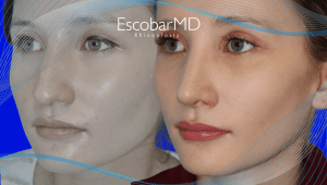 Before After Closed Rhinoplasty in Dubai 4 Closed Rhinoplasty Dr Escobar Dubai