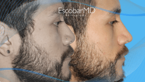 Rhinoplasty in Men Dubai with Dr. Escobar 5 ETHNIC MALE RHINOPLASTY Dr Escobar Dubai
