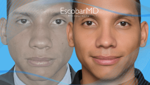 Rhinoplasty in Men Dubai with Dr. Escobar 7 Ethnic Afro Rhinoplasty Dubai