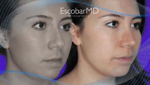 Before After Female Rhinoplasty in Dubai 8 Ethnic Rhinoplasty Dr Escobar Dubai
