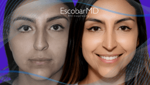 Before After Closed Rhinoplasty in Dubai 3 Ethnic Rhinoplasty Dr Escobar Dubai