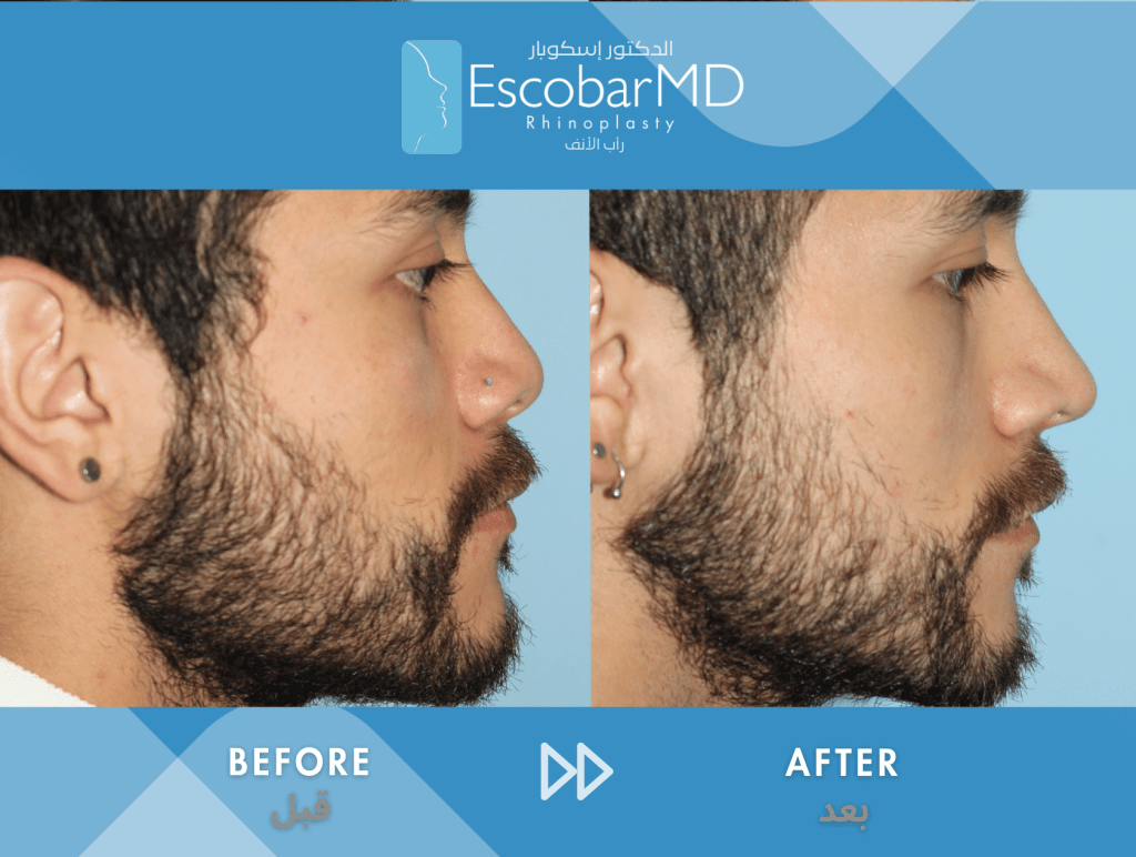 Ethnic Male Rhinoplasty – Augmentation Rhinoplasty in Dubai 1 Ethnic male rhinoplasty Dr Escobar Dubai (10)