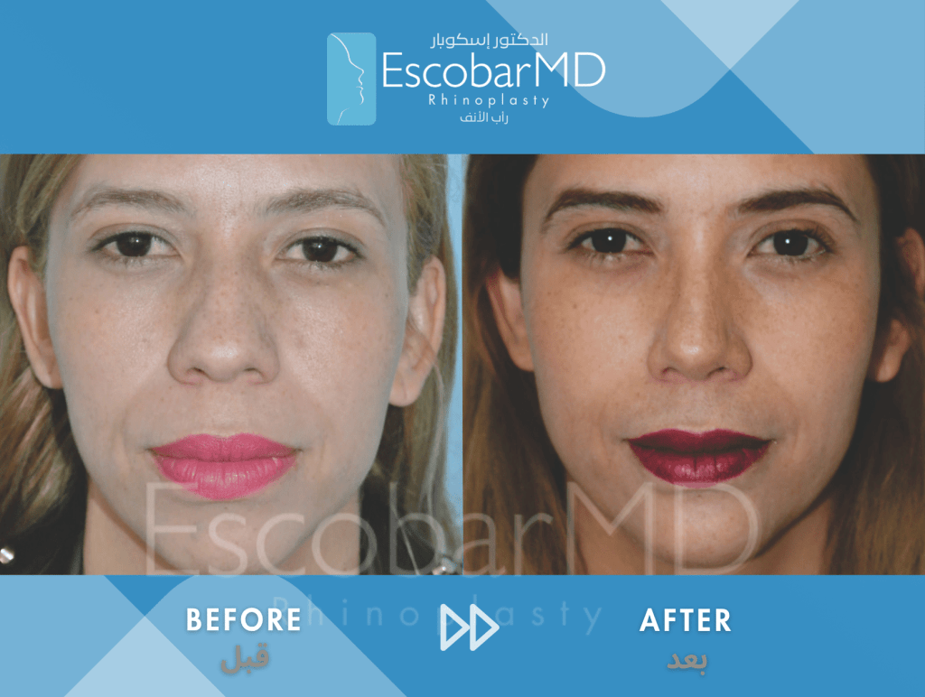 Female Ethnic Rhinoplasty & Chin Implant in Dubai 1 Female Ethnic Rhinoplasty Dr Escobar UAE (1)