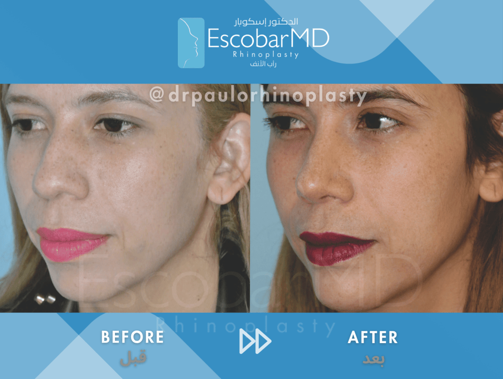 Female Ethnic Rhinoplasty & Chin Implant in Dubai 2 Female Ethnic Rhinoplasty Dr Escobar UAE (2)